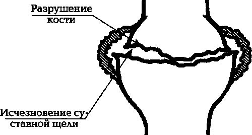 Павел Евдокименко - Артроз. Избавляемся от боли в суставах