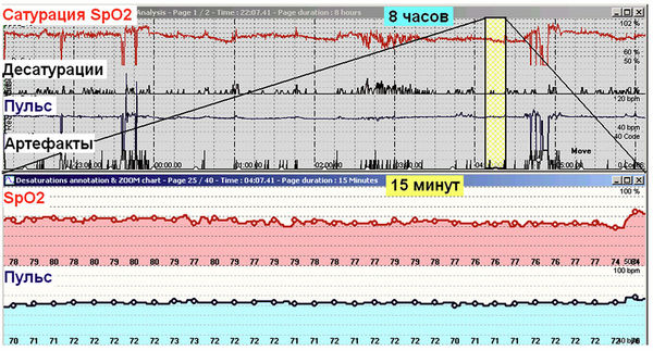 Роман Бузунов, Юрий Кононов и др. - Компьютерная пульсоксиметрия в диагностике...