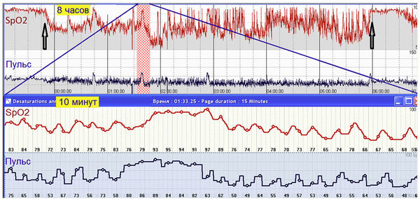 Роман Бузунов, Юрий Кононов и др. - Компьютерная пульсоксиметрия в диагностике...
