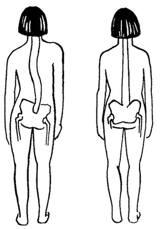 Ирина Калюжнова - Остеохондроз