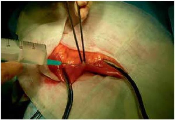 Владимир Мартынов, Коллектив авторов - СИБР (хирургическое лечение и профилактика)