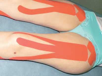 Дмитрий Киселев - Кинезиотейпинг в лечебной практике неврологии и ортопедии