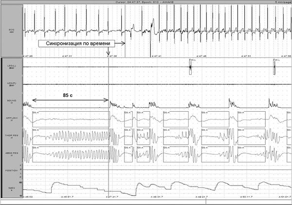Елена Царева, Роман Бузунов и др. - Храп и синдром обструктивного АПНОЭ сна у...