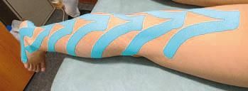 Кинезиотейпинг в лечебной практике...