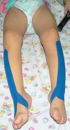 Дмитрий Киселев - Кинезиотейпинг в лечебной практике неврологии и ортопедии