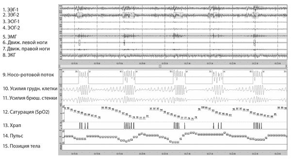 Елена Царева, Роман Бузунов и др. - Храп и синдром обструктивного АПНОЭ сна у...