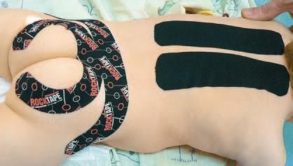 Дмитрий Киселев - Кинезиотейпинг в лечебной практике неврологии и ортопедии