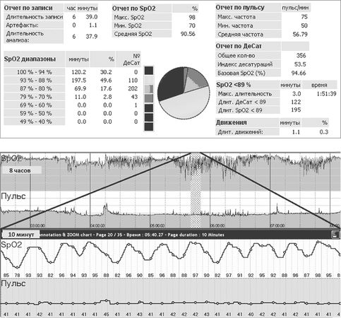 Елена Царева, Роман Бузунов и др. - Храп и синдром обструктивного АПНОЭ сна у...