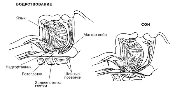 Елена Царева, Роман Бузунов и др. - Храп и синдром обструктивного АПНОЭ сна у...