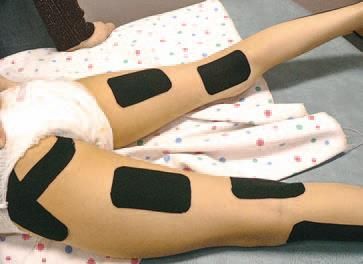 Дмитрий Киселев - Кинезиотейпинг в лечебной практике неврологии и ортопедии