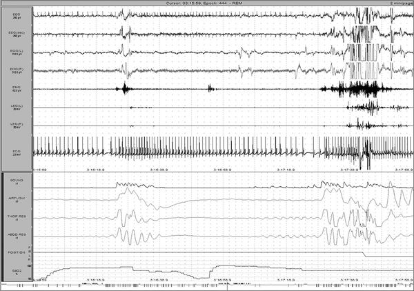 Елена Царева, Роман Бузунов и др. - Храп и синдром обструктивного АПНОЭ сна у...