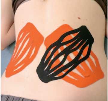 Дмитрий Киселев - Кинезиотейпинг в лечебной практике неврологии и ортопедии