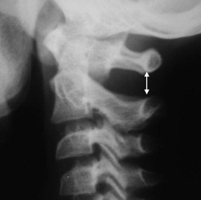 Александр Губин - Острая кривошея у детей: Пособие для врачей