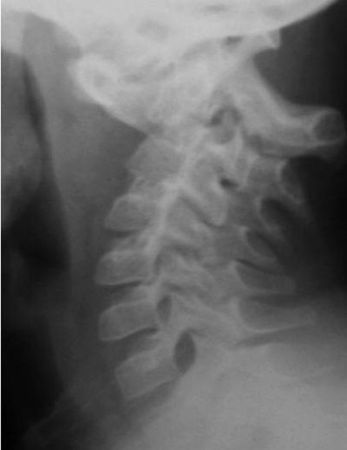 Александр Губин - Острая кривошея у детей: Пособие для врачей