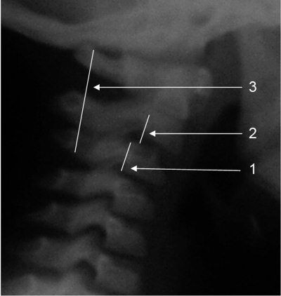 Александр Губин - Острая кривошея у детей: Пособие для врачей