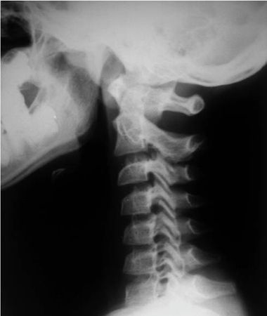 Александр Губин - Острая кривошея у детей: Пособие для врачей