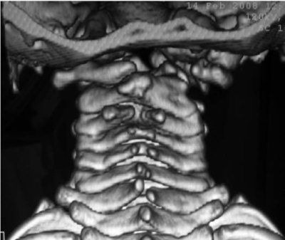 Александр Губин - Острая кривошея у детей: Пособие для врачей