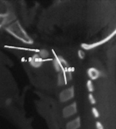 Александр Губин - Острая кривошея у детей: Пособие для врачей