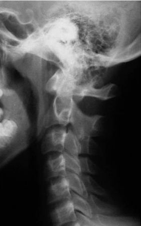 Александр Губин - Острая кривошея у детей: Пособие для врачей