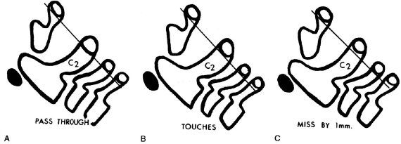Александр Губин - Острая кривошея у детей: Пособие для врачей