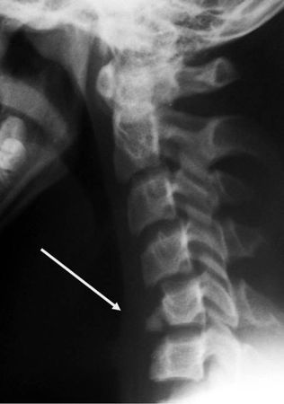 Александр Губин - Острая кривошея у детей: Пособие для врачей