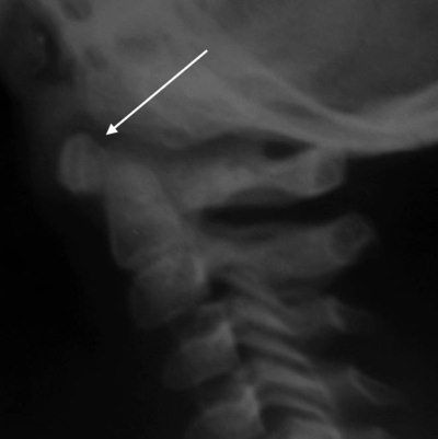 Александр Губин - Острая кривошея у детей: Пособие для врачей