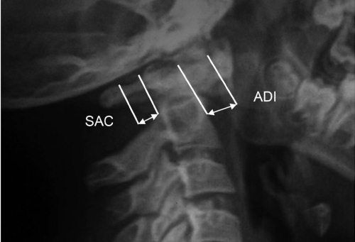 Александр Губин - Острая кривошея у детей: Пособие для врачей