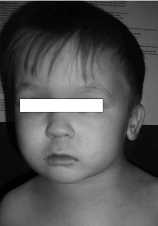 Александр Губин - Острая кривошея у детей: Пособие для врачей