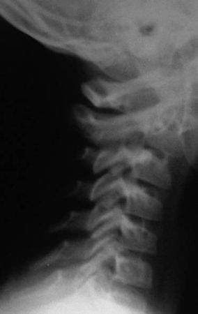 Александр Губин - Острая кривошея у детей: Пособие для врачей