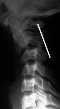 Александр Губин - Острая кривошея у детей: Пособие для врачей
