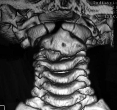 Александр Губин - Острая кривошея у детей: Пособие для врачей