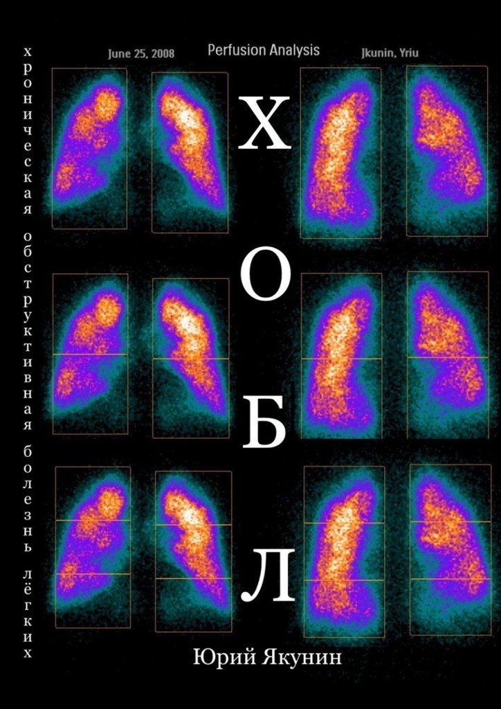 читать ХОБЛ. Хроническая обструктивная болезнь лёгких